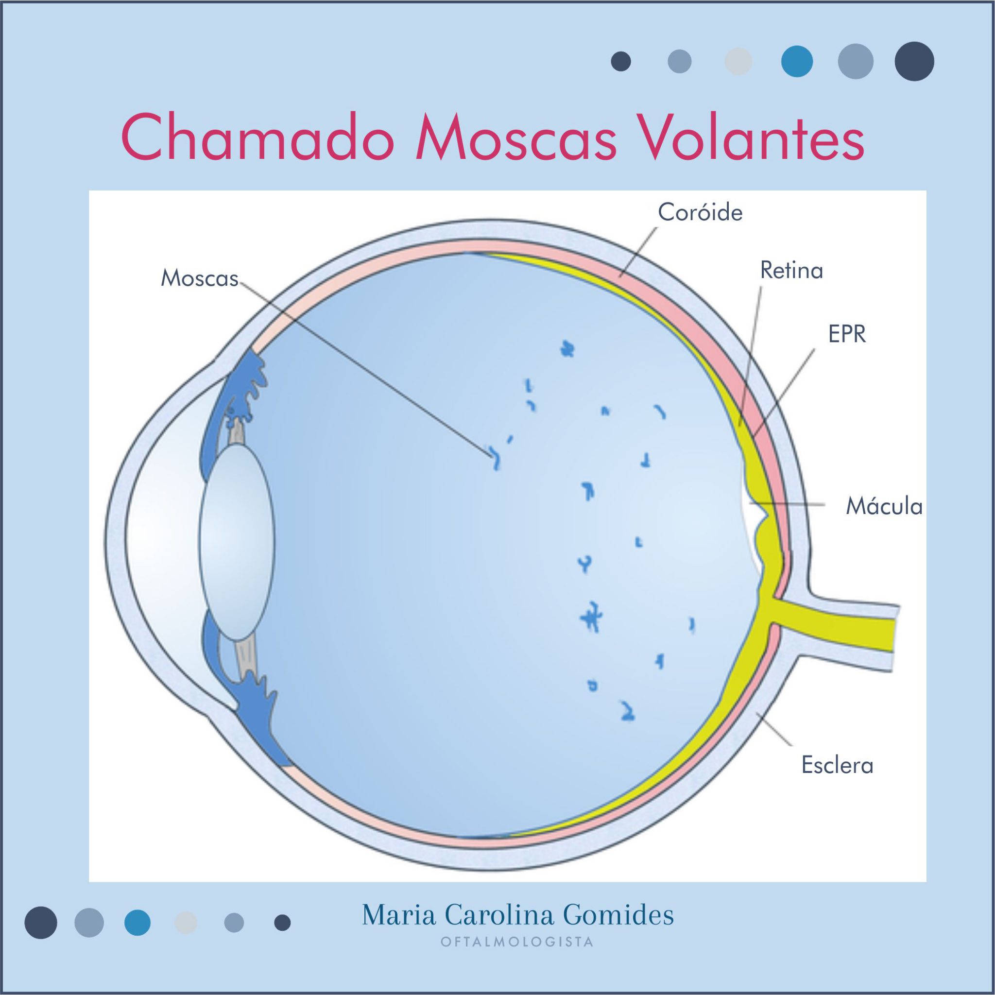 Moscas Volantes – Dra. Carolina Gomides – Oftalmologista São Paulo – SP